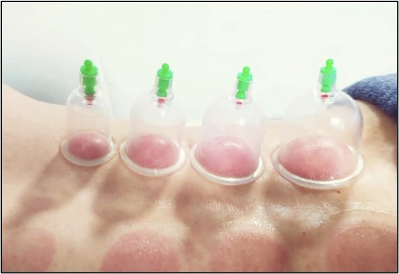 Vendaje neuromuscular